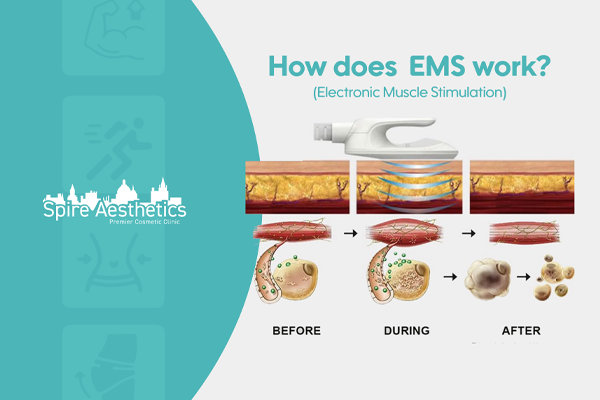 EMS treatment for post pregnancy weight loss treatment Kings Norton