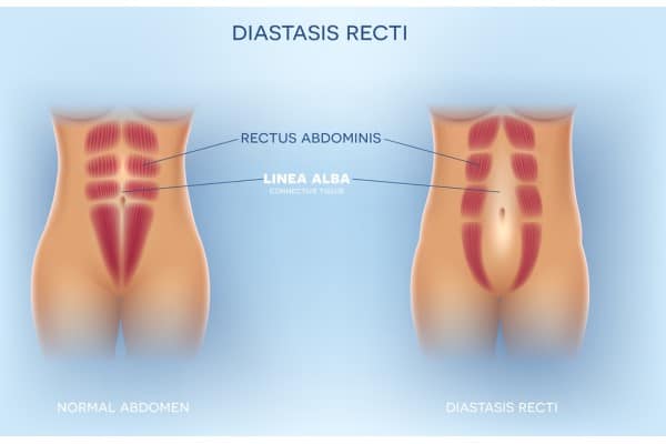 What Non-Surgical Options Are Available for Diastasis Recti Kings Norton?