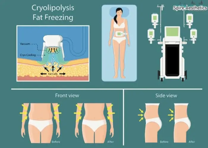 Fat freezing treatment Kings Norton benefits for competitions to remove stubborn fat deposits.