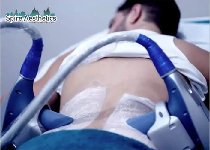 Man having fat freezing treatment done on love handles before a competitions Kings Norton to create a sculpted look.