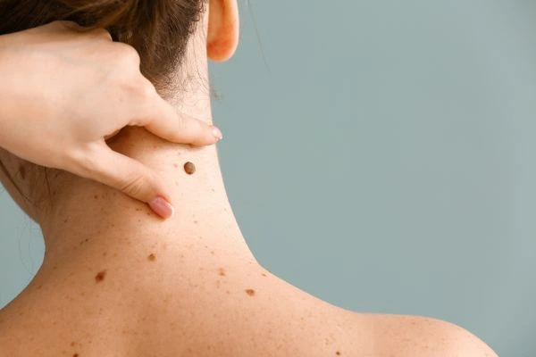 skin blemish removal Kings Norton treatment