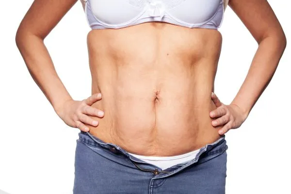 sagging skin on woman's stomach after weight loss injections Kings Norton