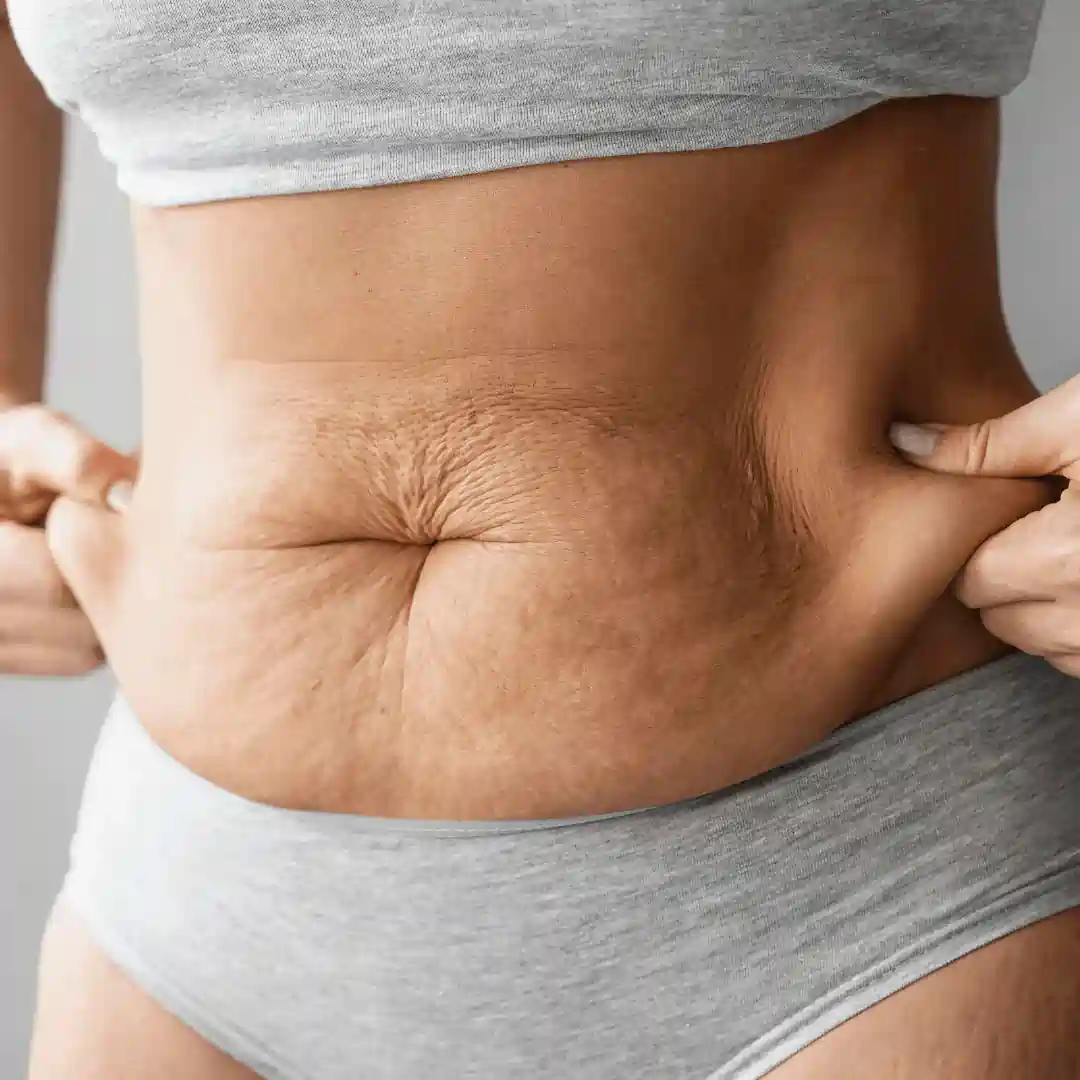Is It Normal to Have Loose Skin After Pregnancy Kings Norton?